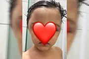 Criança de 3 anos volta para casa com hematomas no rosto após dia na creche
