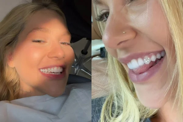 Joia nos dentes: dentista alerta sobre risco de tendência entre influencers