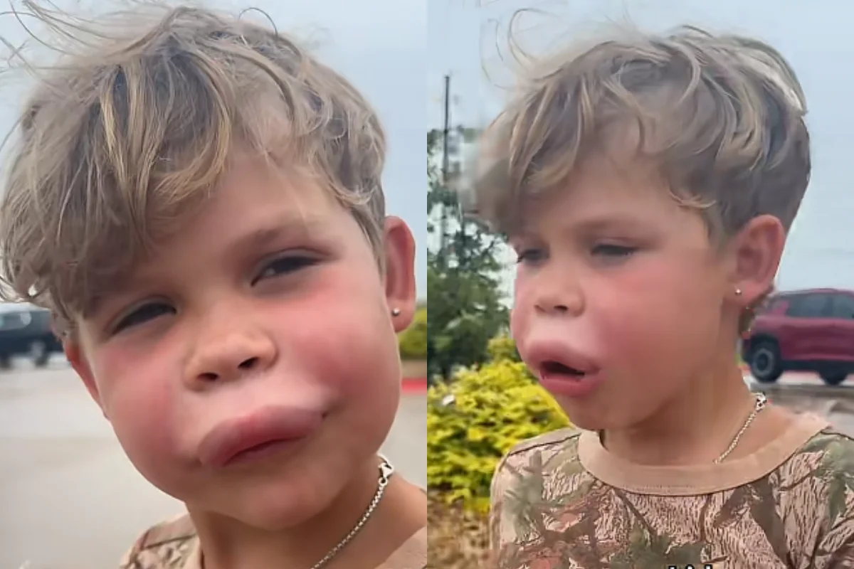 Menino é picado por vespa e reage com tranquilidade ao ver lábio inchado